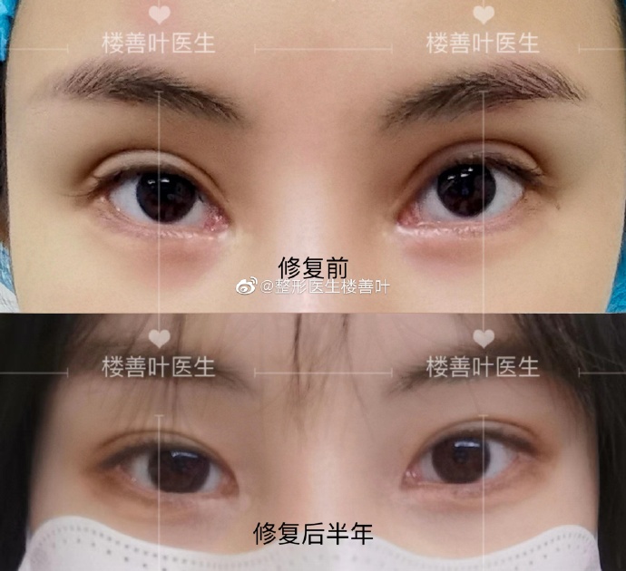 楼善叶和张冰洁谁修复内眼角更厉害