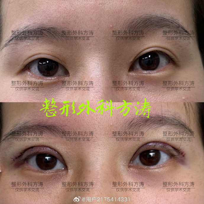 方涛双眼皮修复案例