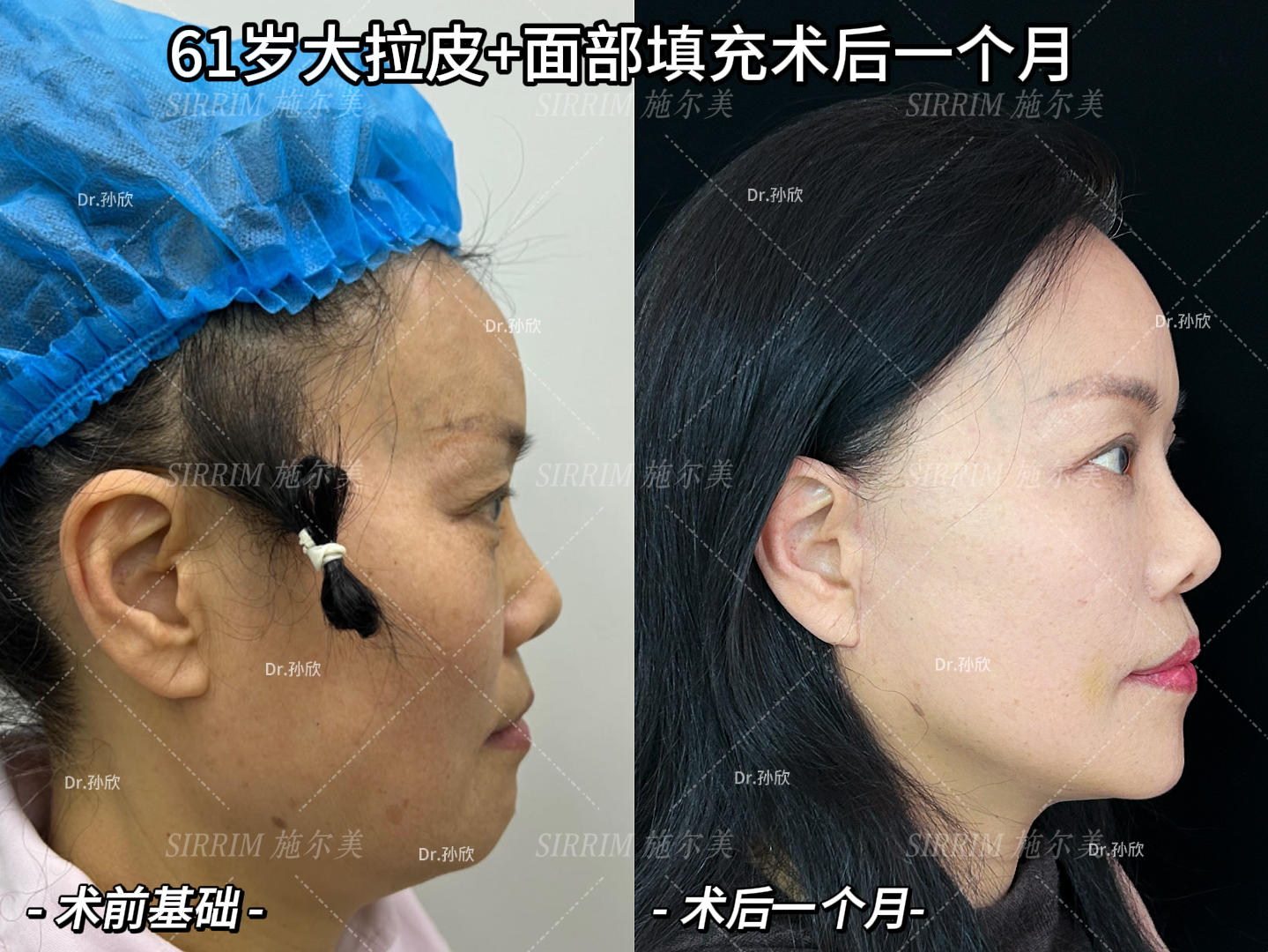 孙欣拉皮手术案例
