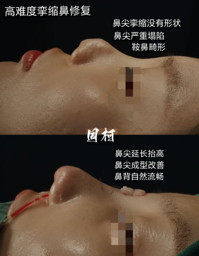 国内擅长做挛缩鼻的专家有哪些？李长富、周仪、刘波？