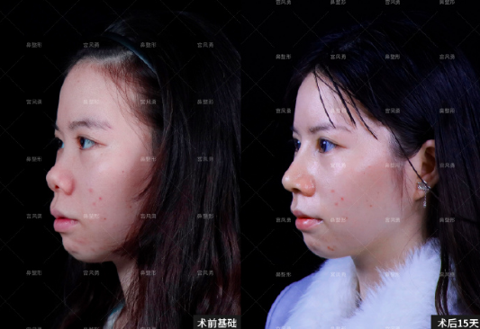 北京做鼻综合最好的医生是哪个？宫风勇、夏正义、李海兵？