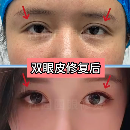 国内双眼皮修复医生哪个厉害？哪个医生技术靠谱？