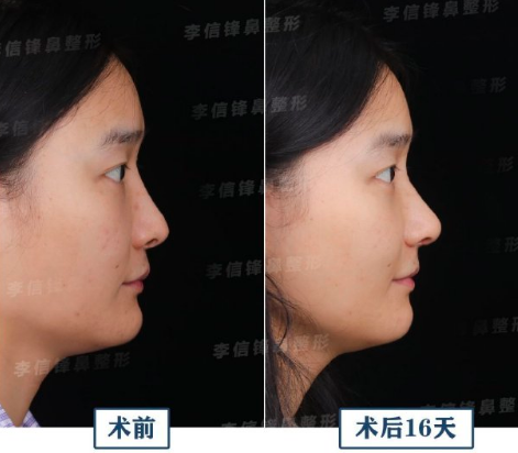 深圳隆鼻最厉害的专家是谁？哪个医生靠谱？