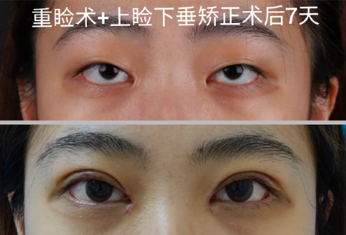 深圳双眼皮做得好的医生是哪个？向萌娟、吕方中、秦菲菲、张双耀？