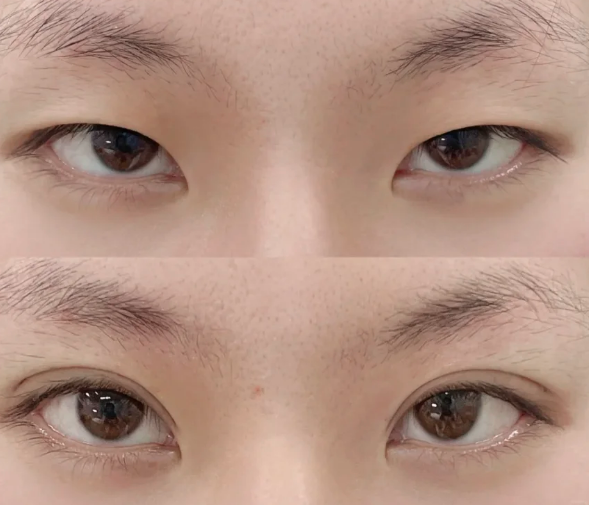 天津割双眼皮好的医生是哪个？卜胜利、于广洋、王宗泽？