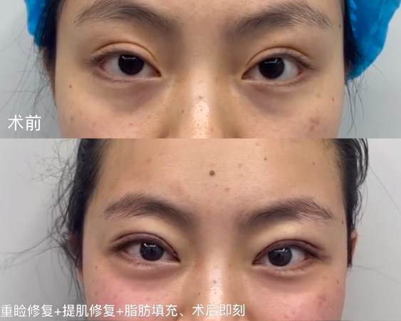 成都双眼皮修复厉害的医生有哪些？