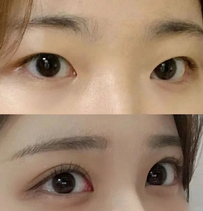 杭州做双眼皮最好的医生是谁？