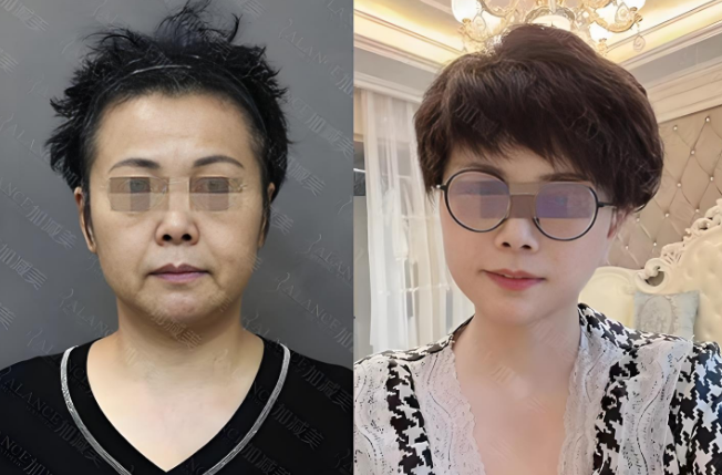 拉皮案例