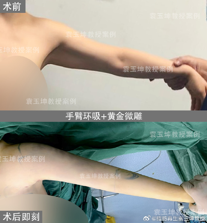 袁玉坤吸脂案例