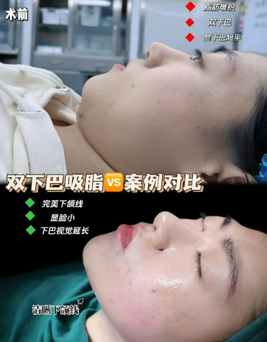 深圳脂肪填充哪个医生技术最好？吸脂技术好的医生？