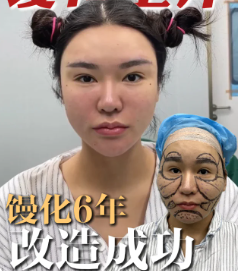 广州馒化修复医生金洪尧技术怎么样？收费贵不贵？