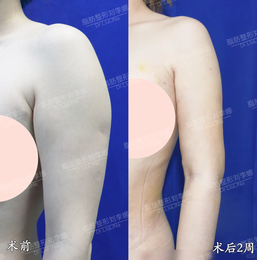 上海刘李娜吸脂技术怎么样？体雕效果好不好？