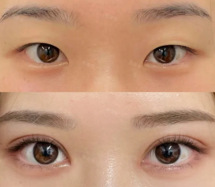 杨荣华双眼皮案例