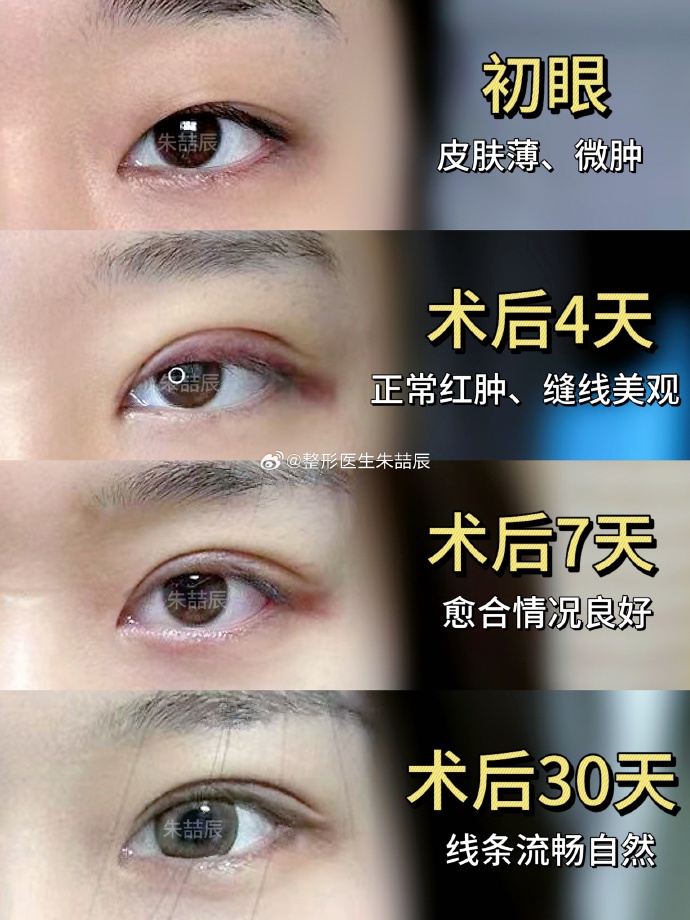 朱喆辰双眼皮案例