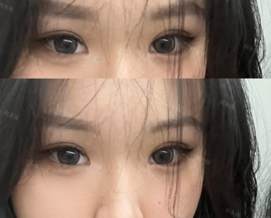 何永强双眼皮案例