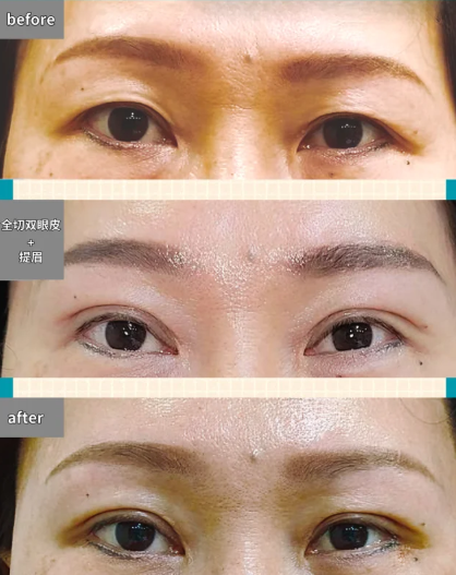 成都李焰和王立鹏割双眼皮哪个好？技术怎么样？