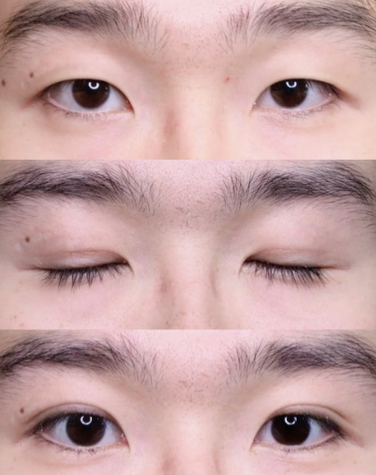 成都练才华和傅荣割双眼皮哪个好？