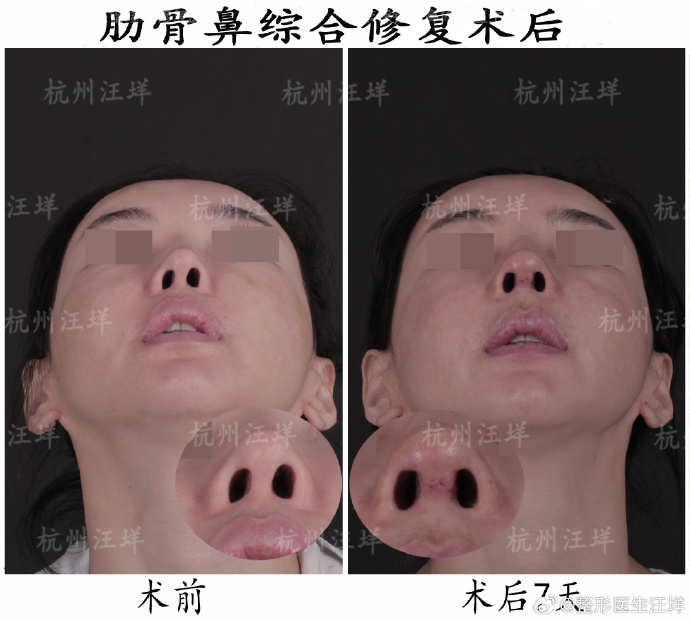 杭州汪垟和李保锴哪个医生做鼻修复更好？