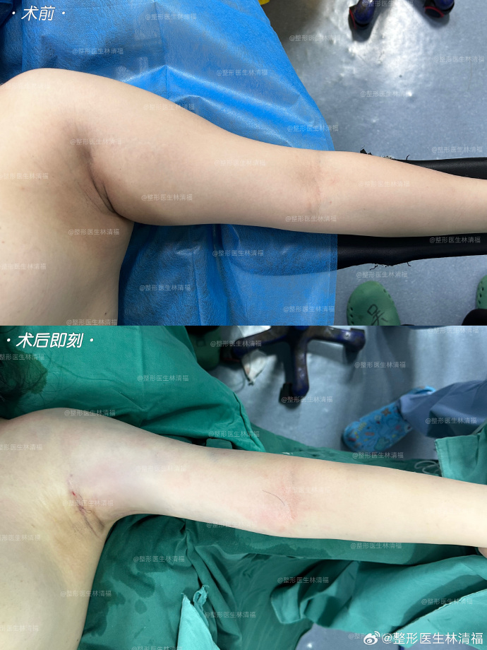 厦门林清福和王阳明哪个医生吸脂好？