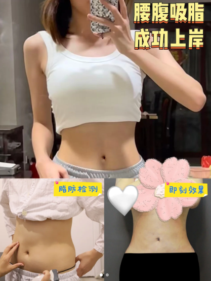 成都吸脂哪个医生做得好？赵善军、郑方荣、王欣、李祥彬、赵善军？