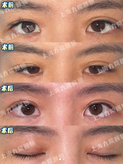 上海九院双眼皮修复医生哪个好？
