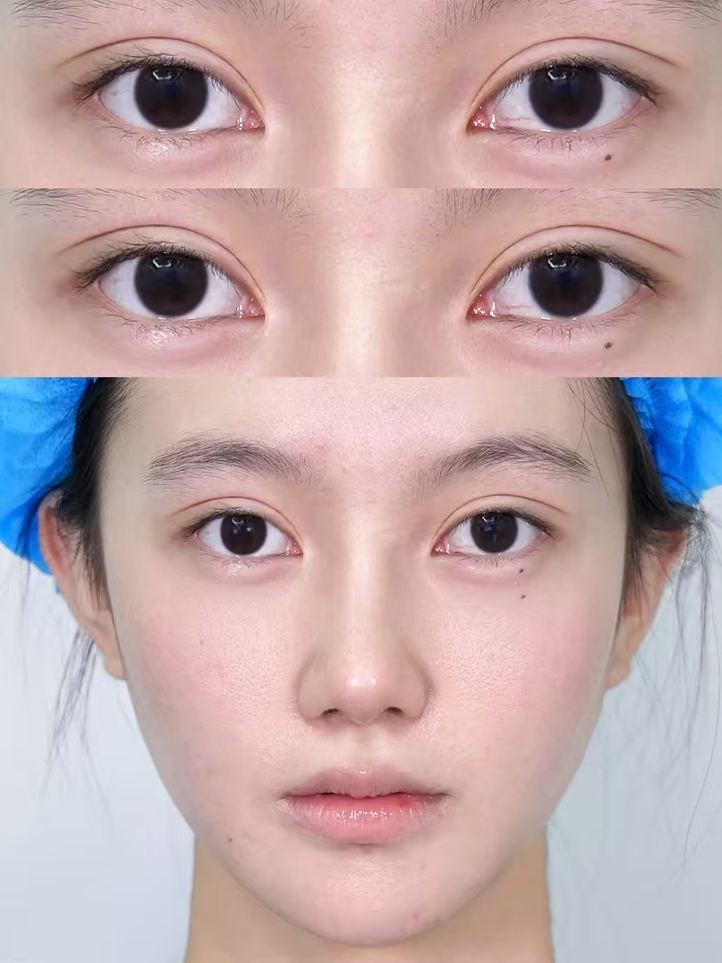 上海双眼皮医生哪个比较好？技术和口碑都好？