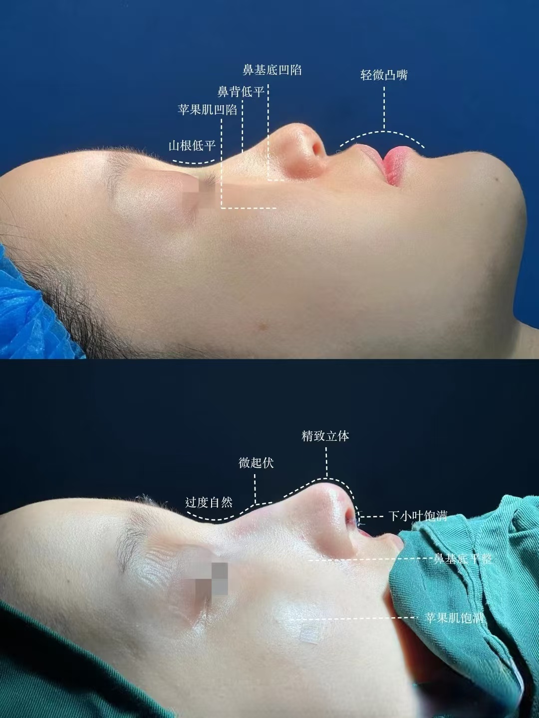 上海隆鼻医生哪个医生技术好？推荐哪个医生？