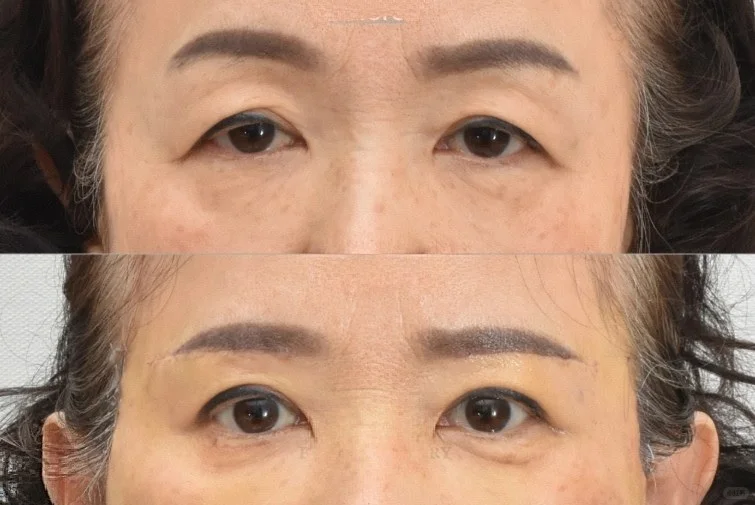 北京陈圣英和梁伟中哪个医生眼周抗衰效果好？
