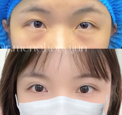 大连双眼皮孟洪君、李研、杨熙哪个医生好？
