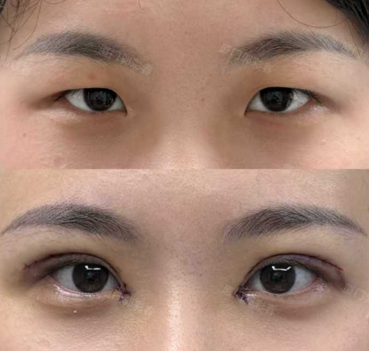 厦门双眼皮郭彩春和张帆哪个医生做的好？