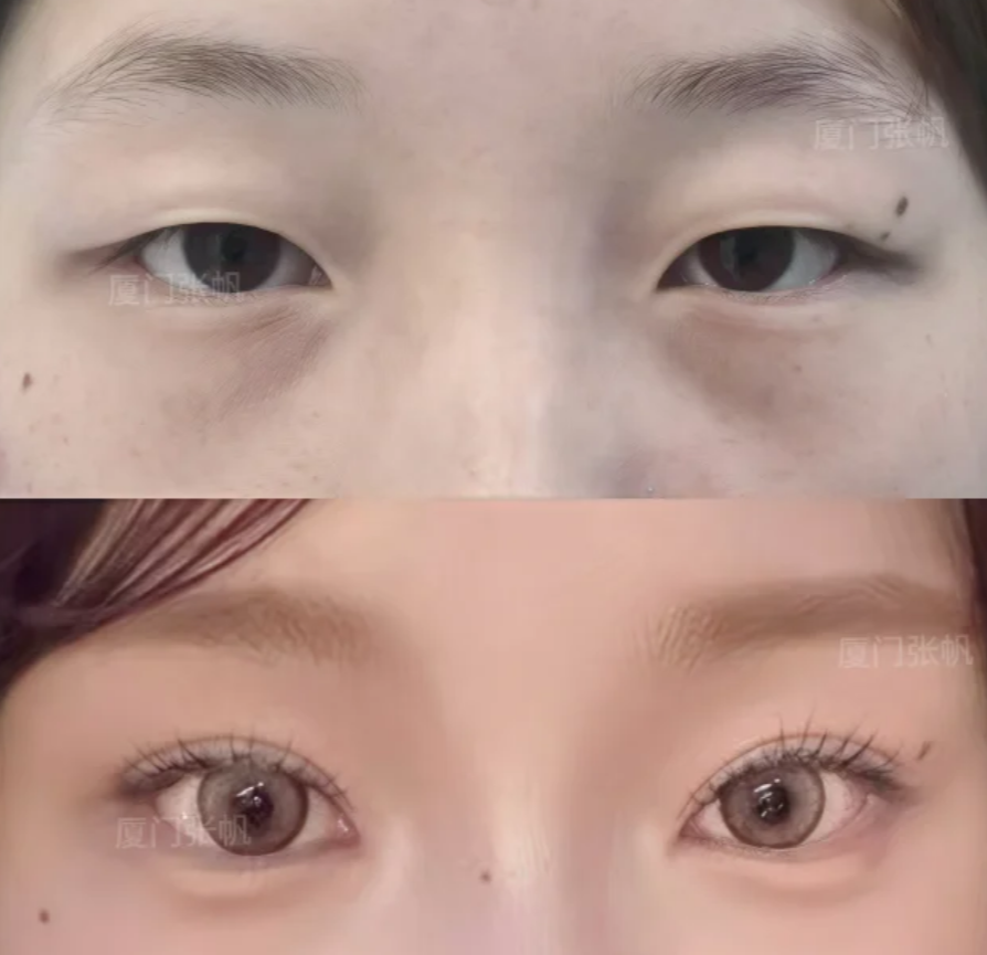 张帆双眼皮