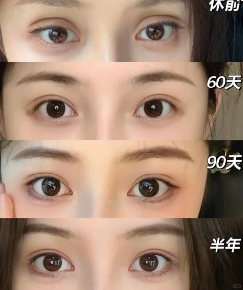 陈双眼皮修复