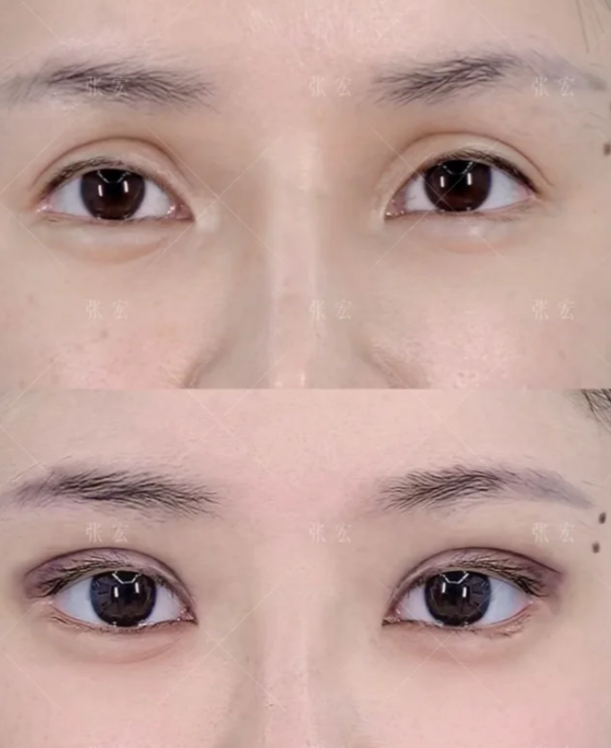 张宏双眼皮修复案例