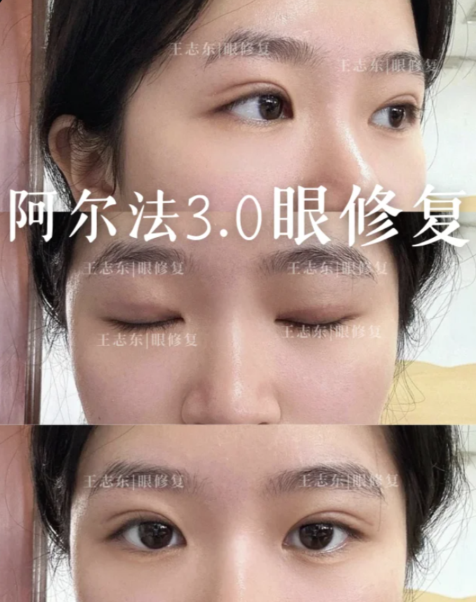 王志东眼修复