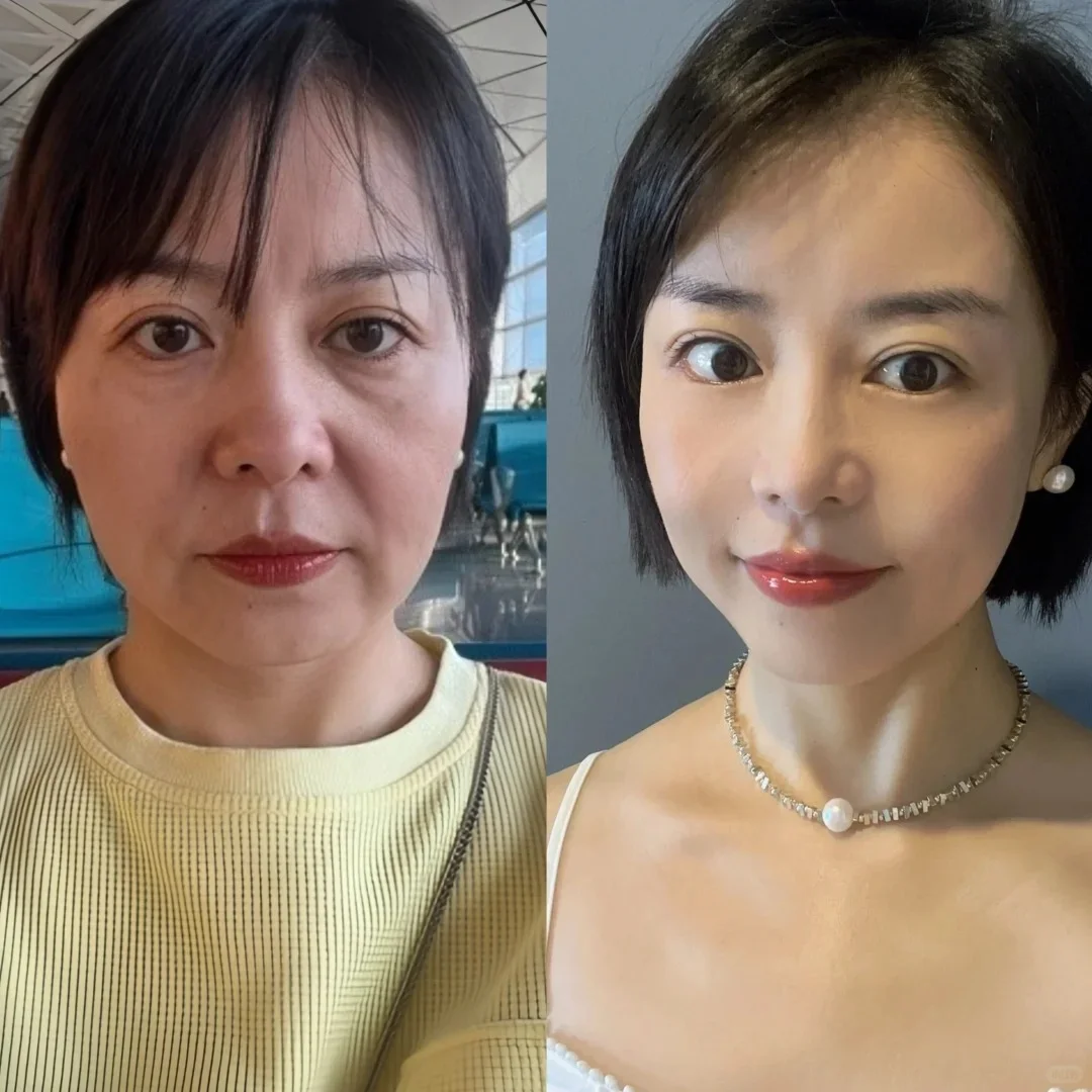王乙立面部提升
