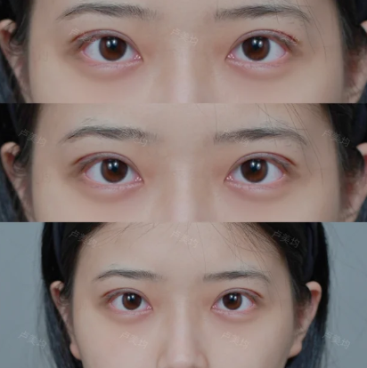 重庆卢美均和王方鹏哪个医生做双眼皮好？