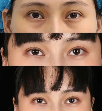 西安双眼皮修复哪个医生好？求推荐！