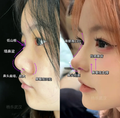 武汉隆鼻最好的医生是谁？邓裴、付毅、李爱林、曾宁、张继强