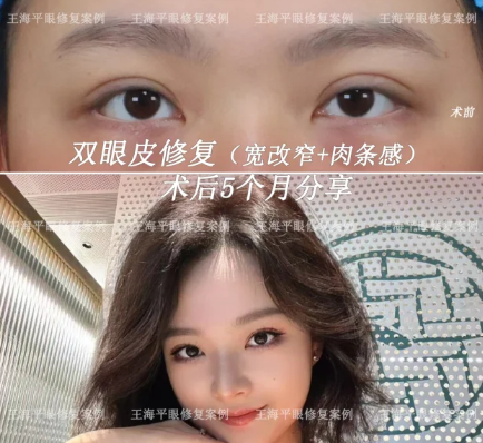 武汉双眼皮修复王海平和方涛哪个修复效果好？