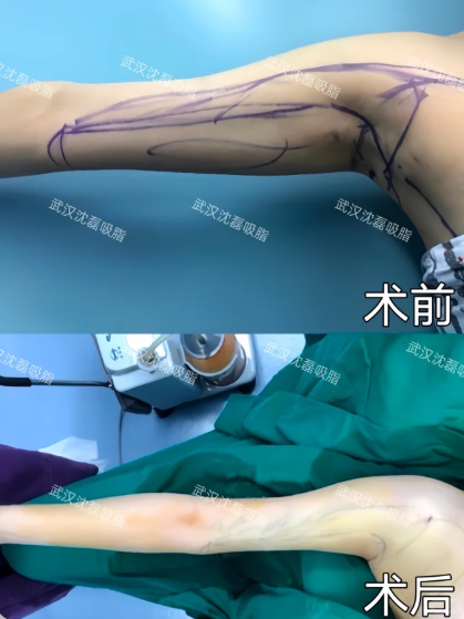 武汉吸脂哪个医生技术最好？