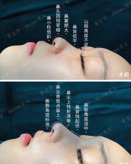 石家庄隆鼻董宏华和苏晓光哪个医生口碑好？