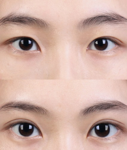 大连王洁晴和李研哪个医生做双眼皮好？