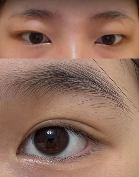王金明双眼皮
