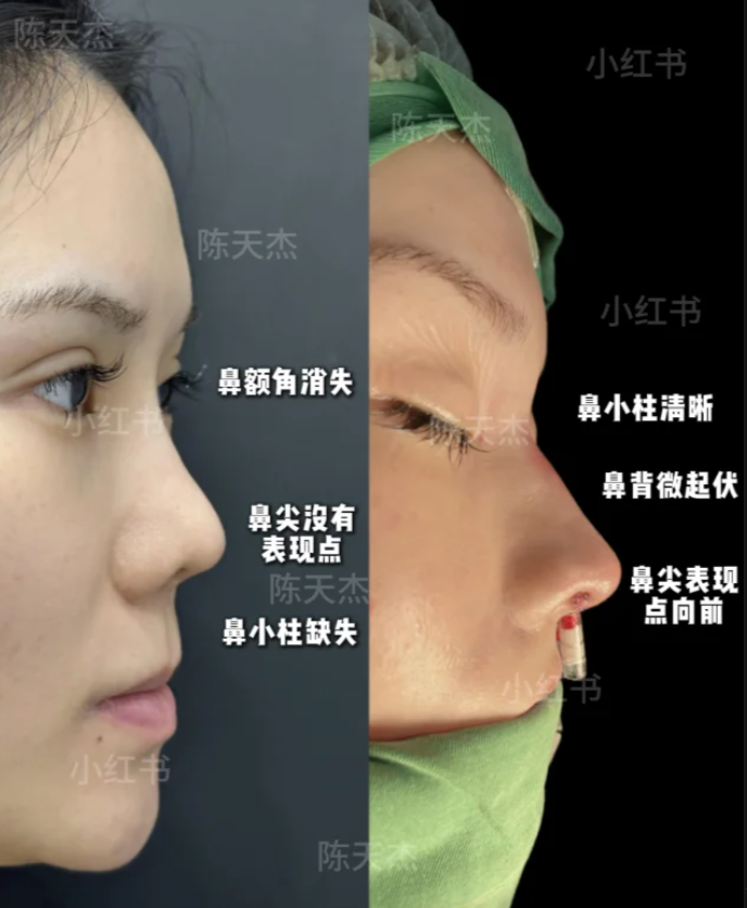 陈天杰鼻修复案例