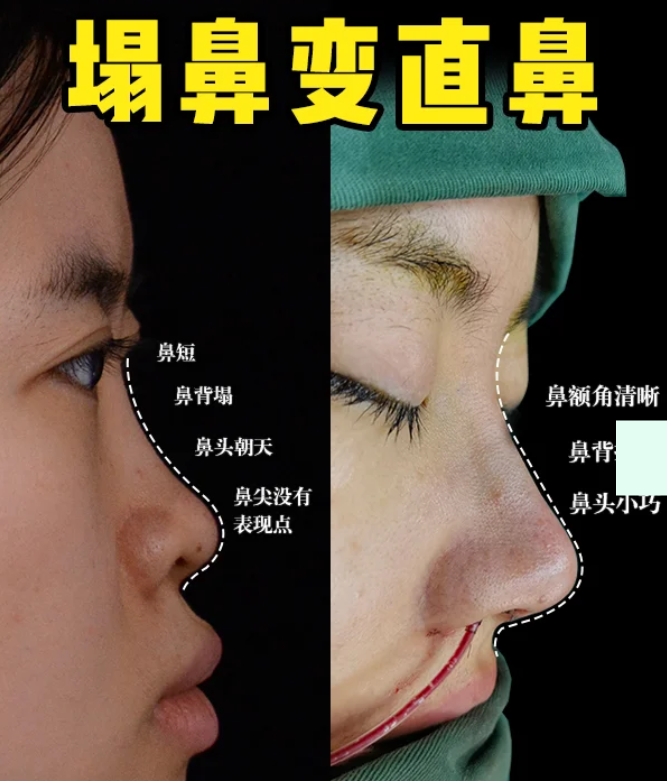 合肥隆鼻医生赵士俊和孙洋哪个技术好？