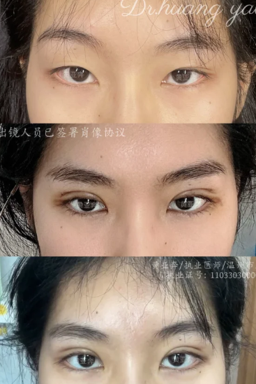 温州黄亚奔、应胡足和李力群哪个医生割双眼皮技术好？
