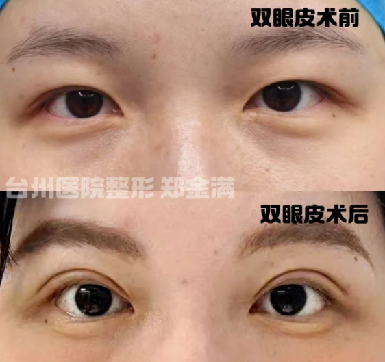 郑金满割双眼皮案例