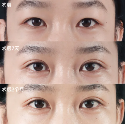 宁波割双眼皮哪个医生好？李晓冬和陈先钱哪个好？