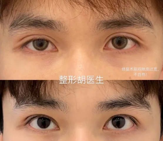 金华双眼皮哪个医生好？胡维君和赵伟哪个好？