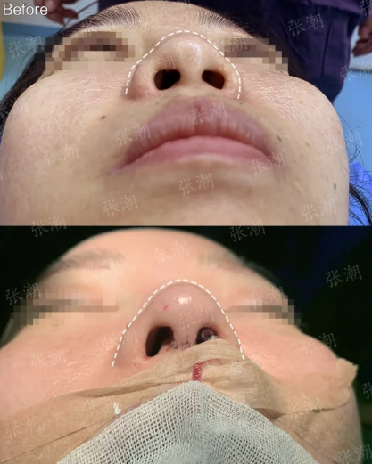 张潮隆鼻案例